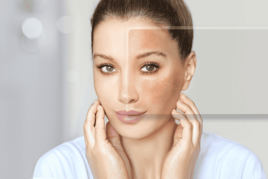 Kojic acid giúp hỗ trợ điều trị nám và tàn nhang hiệu quả