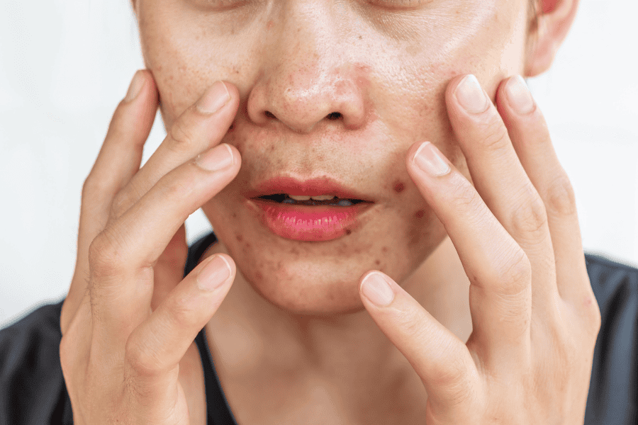 Mặt nạ chuối hỗ trợ điều trị các loại mụn
