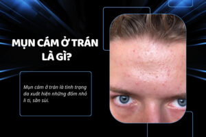 Nổi mụn cám trên trán tuy không ảnh hưởng đến sức khỏe nhưng lại ảnh hưởng nghiêm trọng đến thẩm mỹ