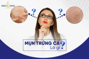 Mụn trứng cá là gì? Mụn trứng cá có nên nặn không? Giải đáp ngay cùng chuyên gia
