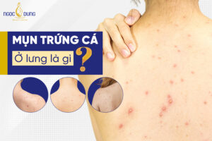 Mách ngay các cách trị mụn trứng cá ở lưng hiệu quả mà chị em không nên bỏ qua