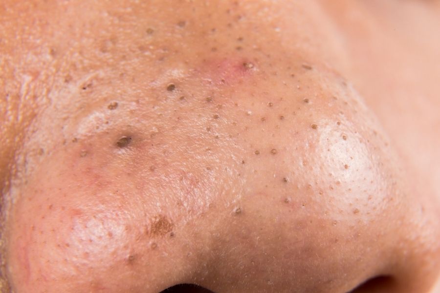 Không nặn mụn có tự hết không? Nếu không nặn mụn thì sao? 6 Cần loại bỏ mụn đầu đen để giảm nguy cơ để lại sẹo thâm