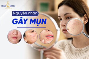 nguyen nhan gay mun
