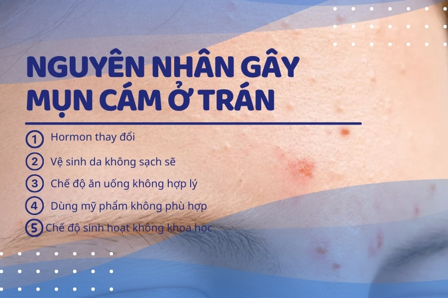 Mụn cám trên trán xuất hiện do nhiều nguyên nhân khác nhau