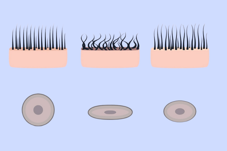Người có lông xoăn dễ khiến lông bị mọc ngược hơn người có lông thẳng