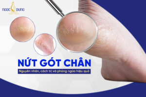 nứt gót chân