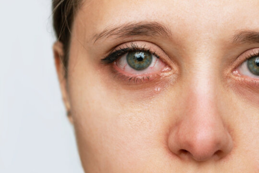 Kem chống nắng có thể làm da vùng mắt bị kích ứng