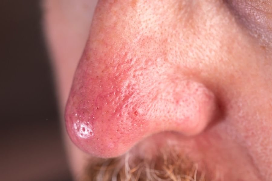 Ở giai đoạn muộn vùng mũi thường bị sưng lớn và tấy đỏ