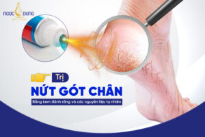 trị nứt gót chân bằng kem đánh răng