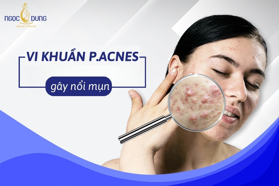 P. acnes là nguyên nhân hàng đâu gây mụn