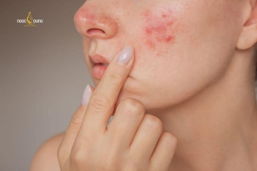 Da mặt bị ngứa sần sùi phải làm sao? Cách xử lý chuẩn 4 Viêm da tiếp xúc có thể làm bạn bị ngứa da mặt sần sùi