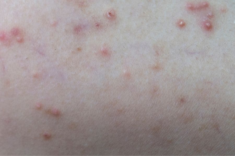 Trường hợp bị viêm lỗ chân lông ở nách do nhiễm virus