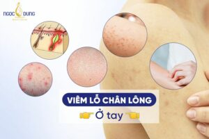 Viêm lỗ chân lông ở tay? Cách chữa viêm lỗ chân lông ở tay