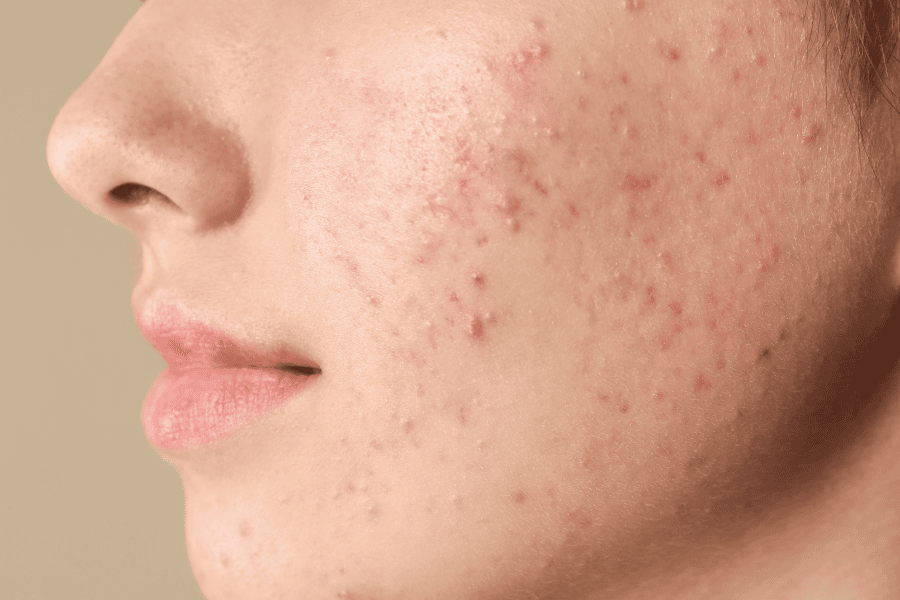 Tác dụng Vitamin A và bí quyết sở hữu làn da không tuổi 4 Vitamin A giúp kiểm soát dầu thừa và hỗ trợ điều trị mụn trứng cá tận gốc