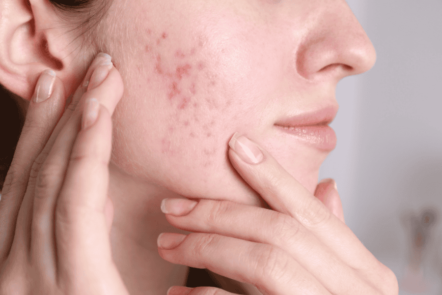 Vitamin B5 không chỉ ngăn mụn hình thành mà còn xử lý hậu quả do mụn để lại