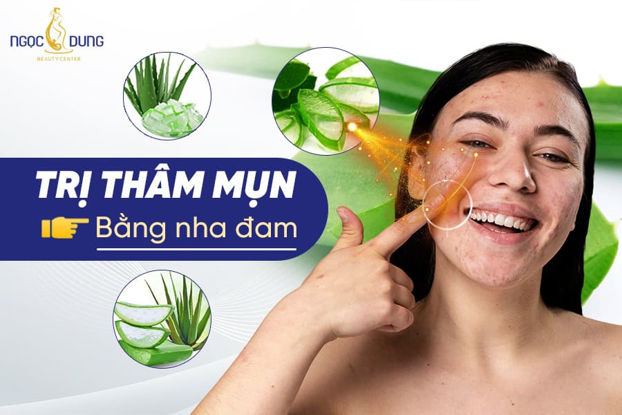 14 Cách trị thâm mụn bằng nha đam hiệu quả