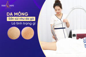 Da mông sần sùi như da gà