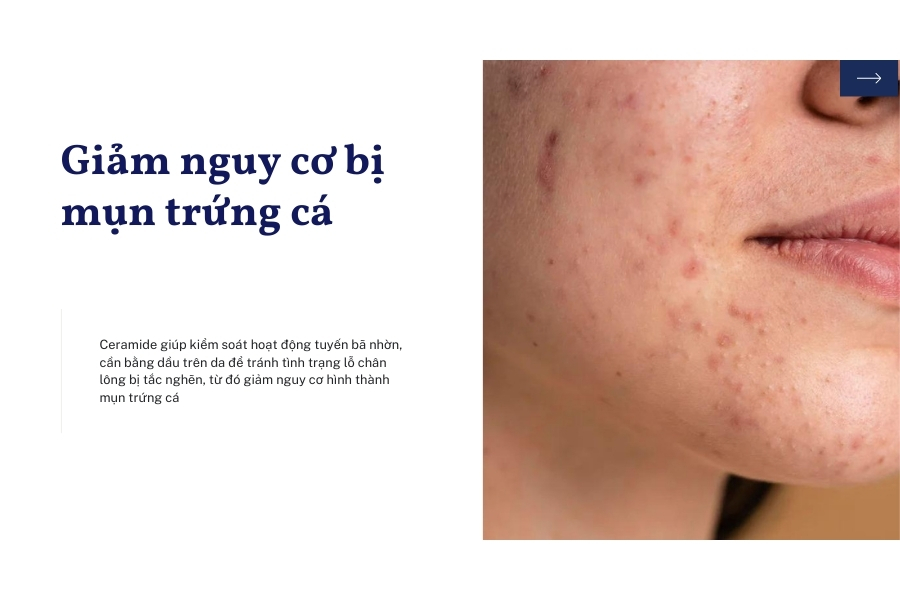 Ceramide có tác dụng gì đối với da mụn trứng cá?