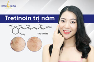 Có nên dùng Tretinoin để trị nám hay không?