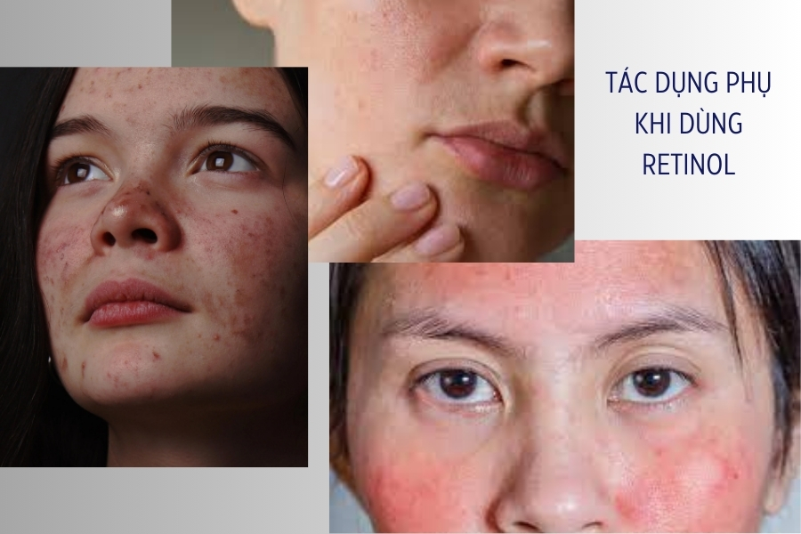 Bên cạnh những tác dụng cho da, Retinol cũng sẽ gây ra một số dấu hiệu kích ứng nhất định 