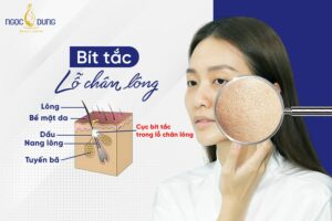 Bít tắc lỗ chân lông? Bật mí cách chữa bít tắc lỗ chân lông hiệu quả tại nhà