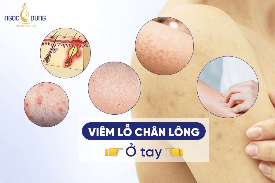 Viêm lỗ chân lông ở tay: Nguyên nhân, dấu hiệu và cách điều trị hiệu quả 2 Cách điều trị viêm lỗ chân lông ở tay