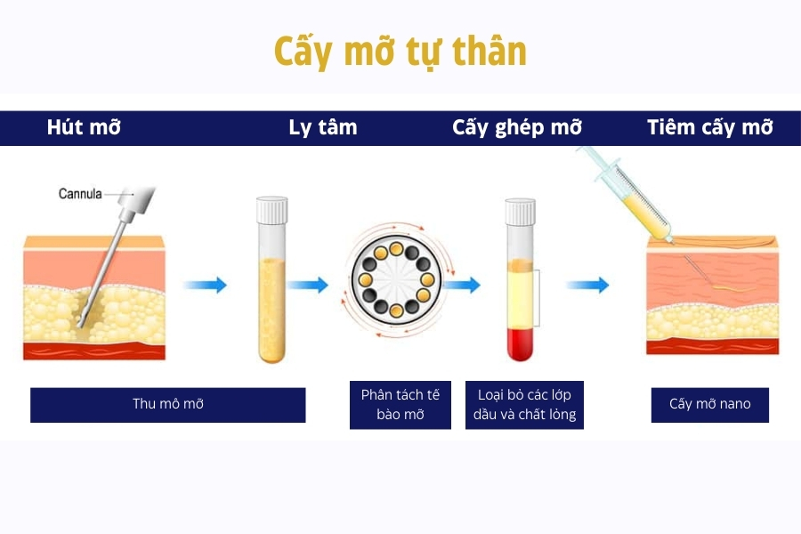 Trẻ hóa bàn tay bằng công nghệ cấy mỡ tự thân