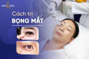 Tổng hợp các cách trị bọng mắt an toàn, hiệu quả, các nàng không nên bỏ qua