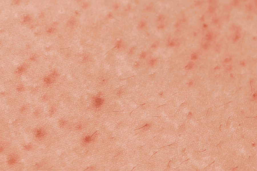 Viêm lỗ chân lông ở tay: Nguyên nhân, dấu hiệu và cách điều trị hiệu quả 4 Cần phân biệt rõ giữa viêm lỗ chân lông và các tình trạng da liễu khác để có phương pháp điều trị phù hợp