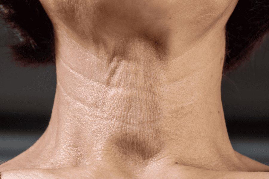 Cần trẻ hóa da cổ sớm để giữ làn da mịn màng, ít vết nhăn trên vùng cổ