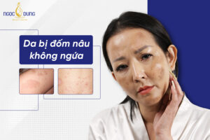 Da nổi đốm nâu không ngứa là do đâu? Cách điều trị hiệu quả