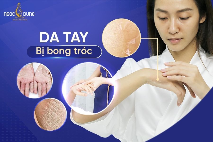 Da tay bị bong tróc do những nguyên nhân nào? Tìm hiểu ngay