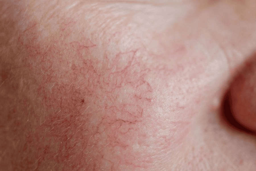 7 cách phục hồi da mỏng yếu hiệu quả và quy trình chuẩn 6 Dấu hiệu của da mỏng yếu là xuất hiện mạch máu nhỏ li ti ở má và cạnh mũi