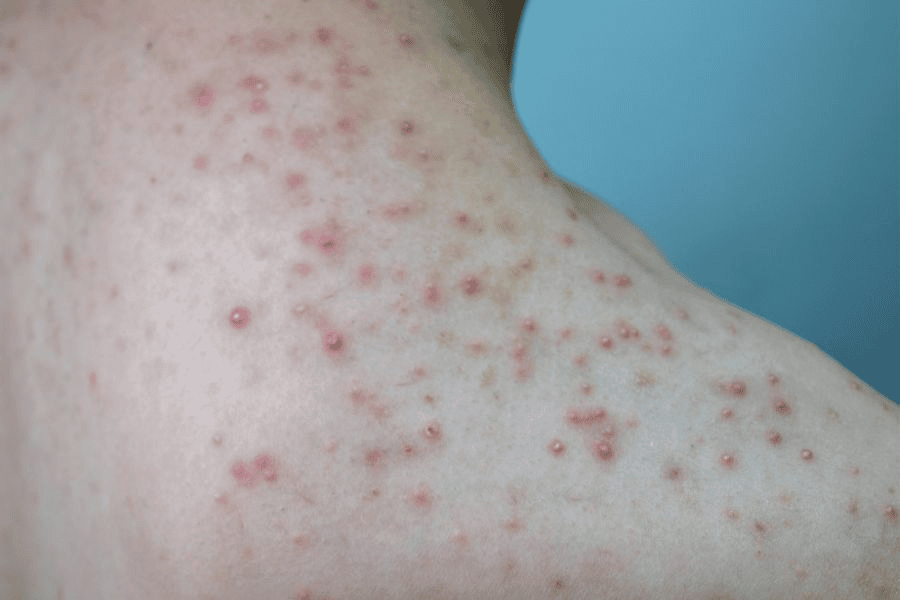 Viêm lỗ chân lông ở tay: Nguyên nhân, dấu hiệu và cách điều trị hiệu quả 3 Dấu hiệu viêm nang lông ở tay là các nốt đỏ hoặc sẩn viêm tập trung quanh chân lông