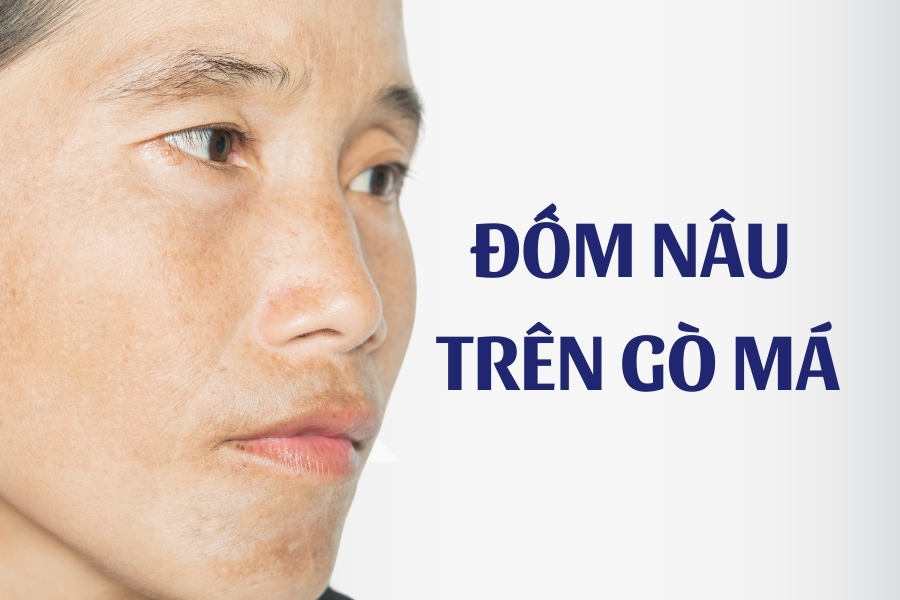 Đốm nâu trên gò má được hình thành do quá trình tăng sắc tố khi tiếp xúc thường xuyên với tia UV