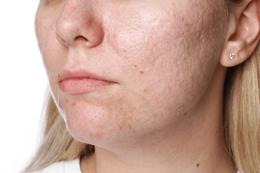 Tác dụng của Omega 3 với làn da mà bạn cần biết ngay nhé 5 Kết hợp Omega 3 với công nghệ Laser Picosuapro giúp làm mờ sẹo rỗ, sẹo lõm