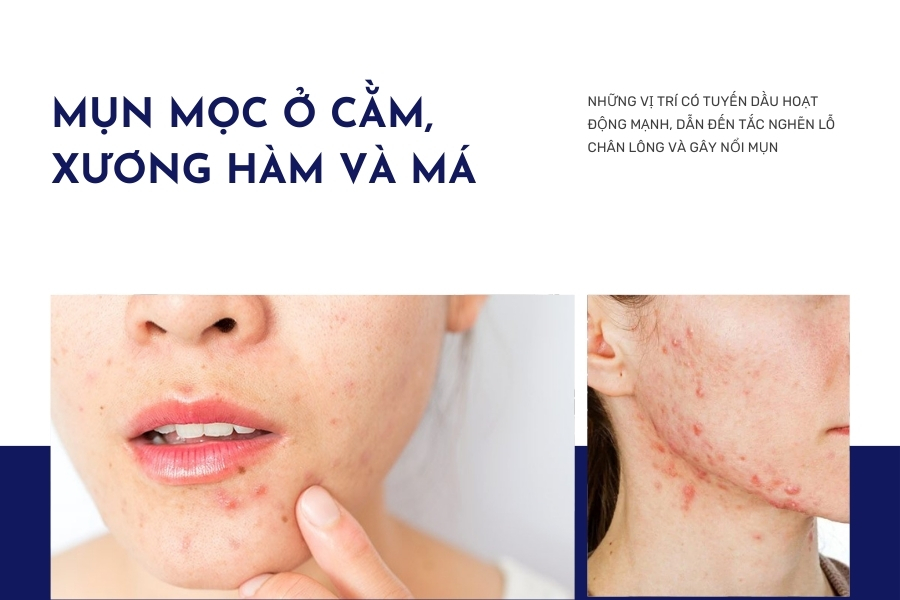 Nổi nhiều mụn ở vùng cằm và xương hàm