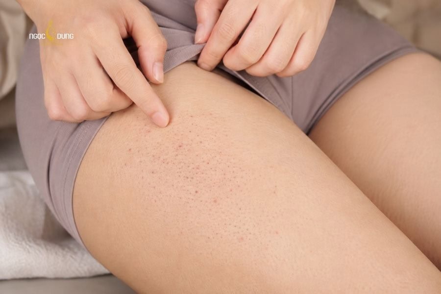 Dấu hiệu lông mọc ngược và cách xử lý triệt để nhất 5 Mặc quần áo quá bó sát cũng dễ gây ra tình trạng lông mọc ngược