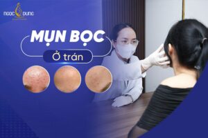 Nguyên nhân và cách điều trị mụn bọc ở trán nhanh nhất