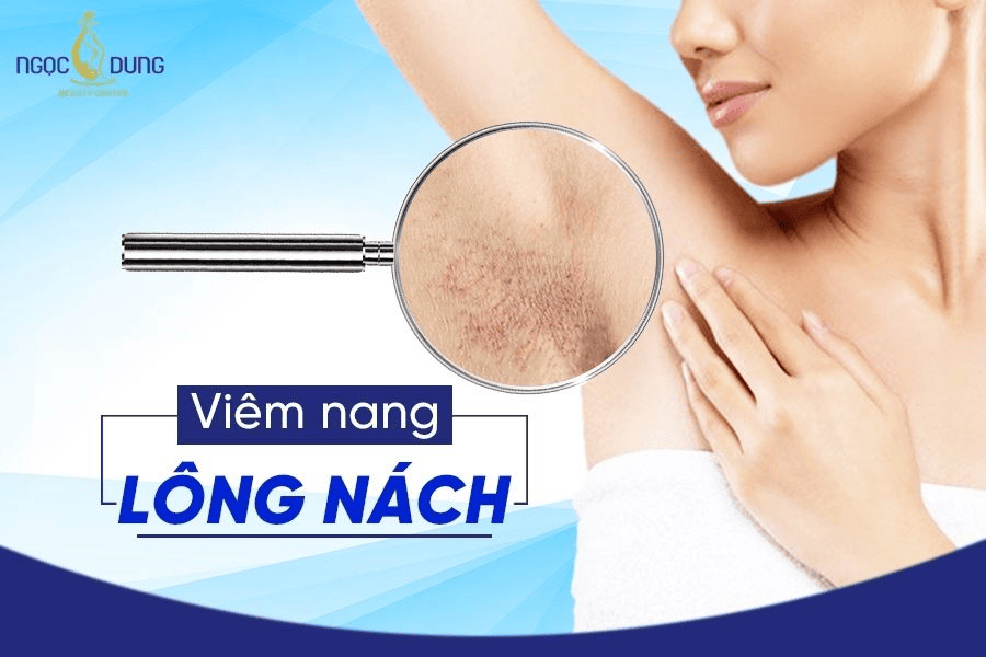 Nguyên nhân, dấu hiệu và cách điều trị viêm nang lông nách