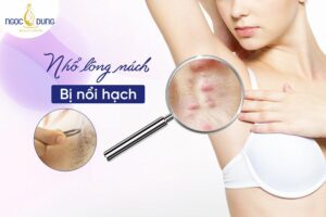 Nhổ lông nách bị nổi hạch do những nguyên nhân nào gây ra? Giải đáp ngay cùng chuyên gia