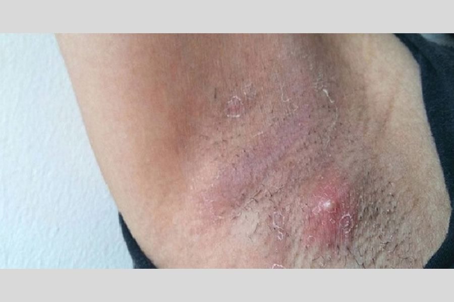 Nhổ lông nách làm tổn thương da và kích thích hệ bạch huyết hoạt động làm nổi hạch ở nách