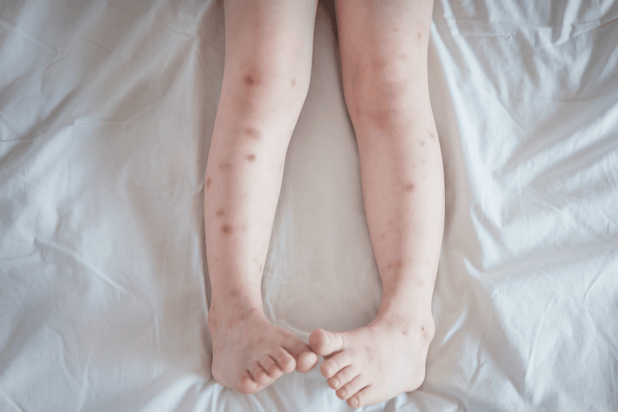 Sẹo thâm ở chân có thể mờ dần nếu ở mức độ nhẹ 