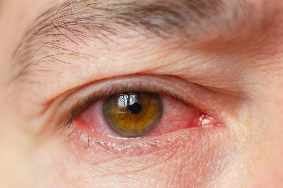 Tia UV gây tác hại đến mắt và vùng da quanh mắt