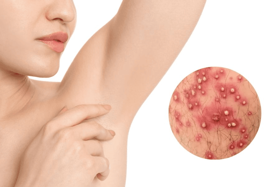 Thói quen cạo hoặc nhổ lông nách không đúng cách khiến vi khuẩn thâm nhập dẫn đến viêm nang lông