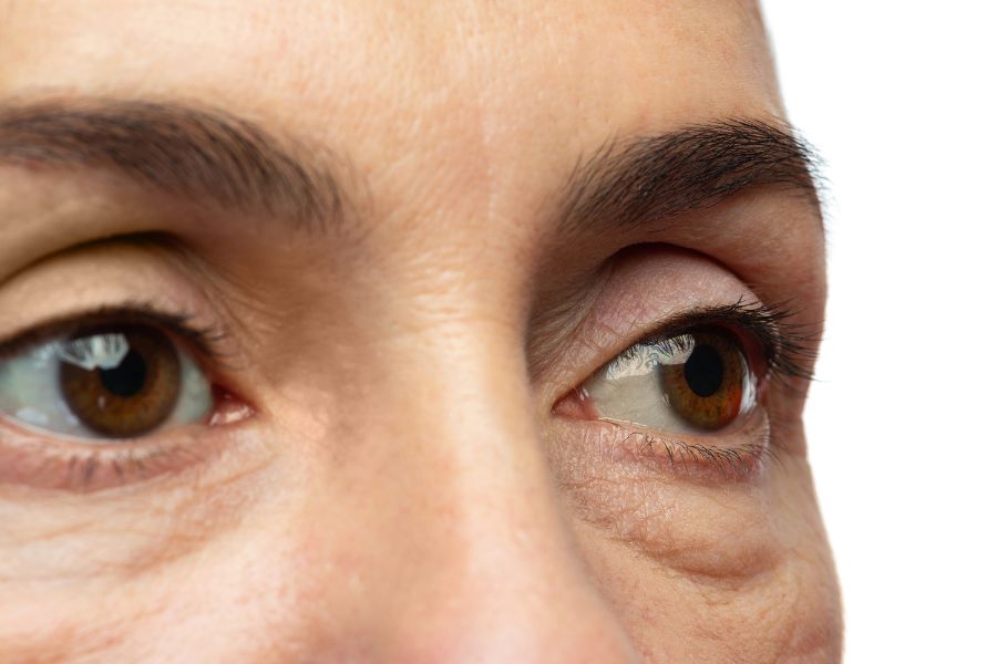 Bọng mắt là tình trạng mắt bị sưng và phồng nhẹ do cơ mí mắt bị yếu đi theo thời gian
