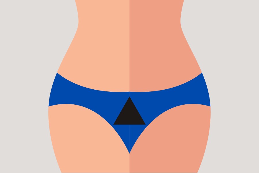 Triệt lông bikini tạo hình tam giác