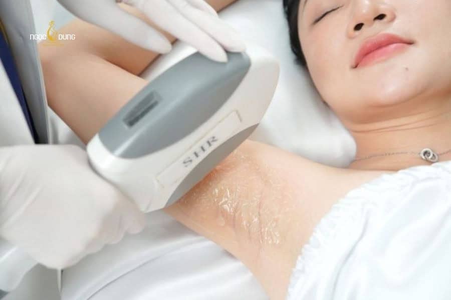 Dấu hiệu lông mọc ngược và cách xử lý triệt để nhất 7 Triệt lông an toàn và tránh viêm nang lông tại Ngọc Dung