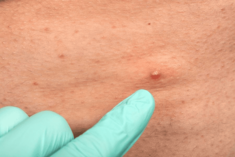 Vi khuẩn tụ cầu vàng là tác nhân phổ biến nhất gây viêm nang lông nông và sâu