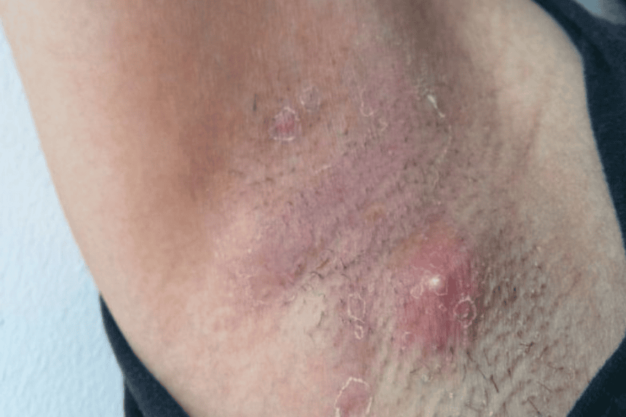 Viêm nang lông nách là phản ứng viêm nang lông tại vùng da dưới cánh tay, do vi khuẩn, nấm,... gây ra